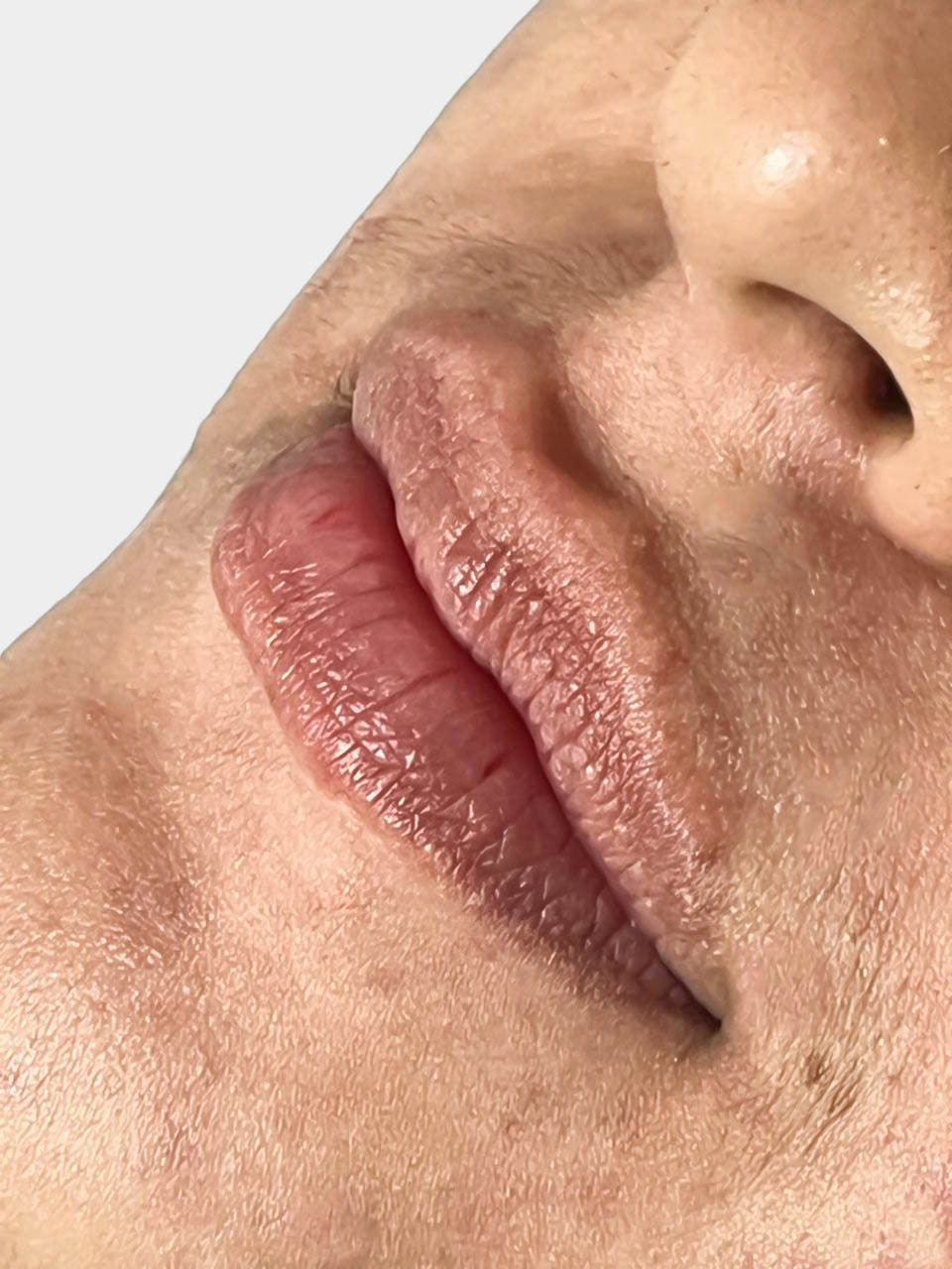 Antes de Fillers de Labios